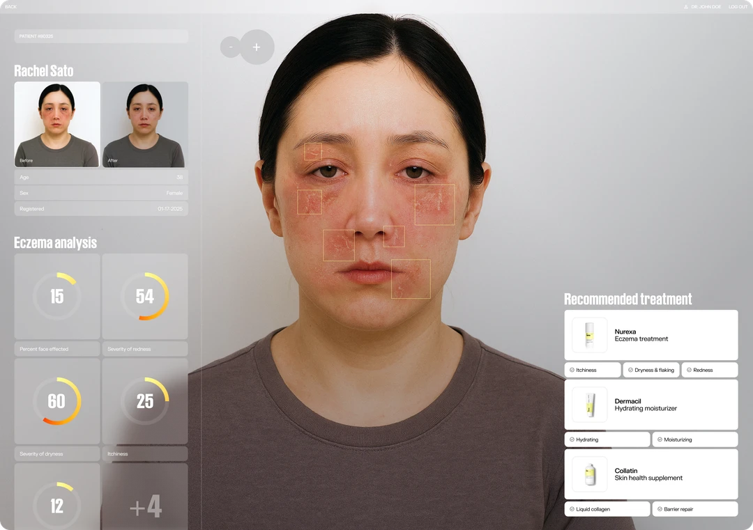 Eczema