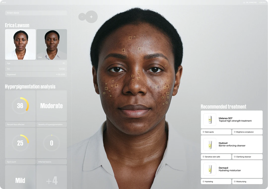 Hyperpigmentation